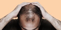 ۶ ریزمغذی موثر در جلوگیری از ریزش مو