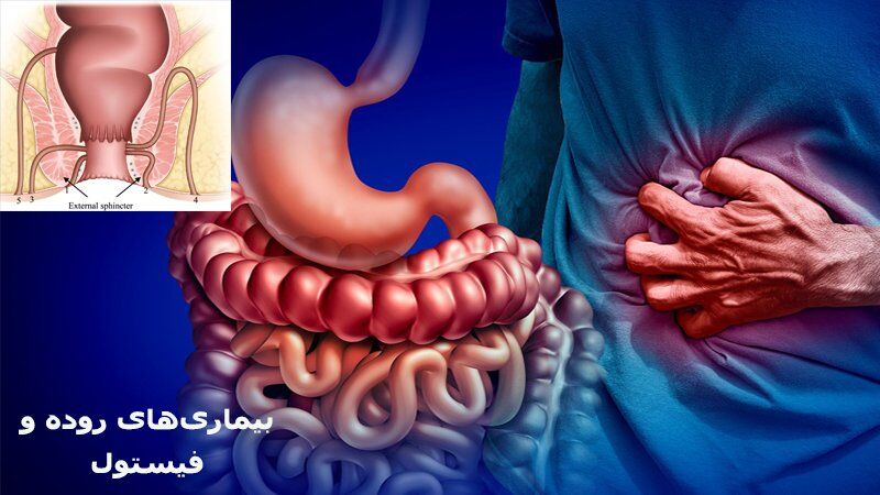 آیا بیماریهای التهابی روده مثل کرون باعث فیستول میشود؟ آیا بیماریهای التهابی روده مثل کرون باعث فیستول میشود؟