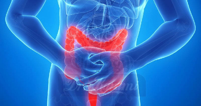 چهار نکته پیشگیری از التهاب روده کدامند چهار نکته پیشگیری از التهاب روده کدامند