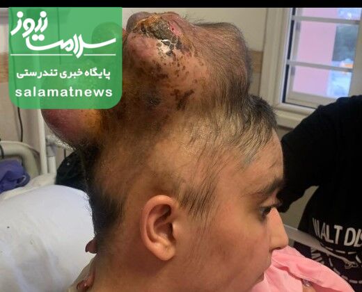 عکس/جزئیات خروج تومور ۳.۵ کیلویی از مغز دختر نوجوان