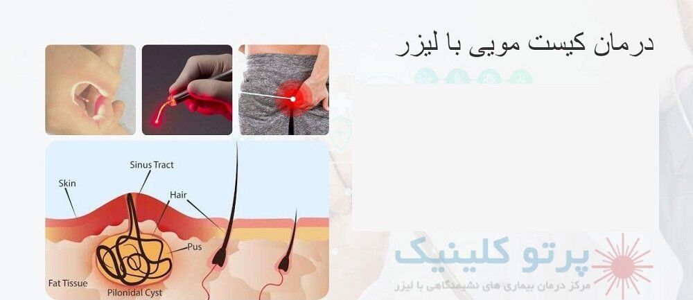 معجزه درمان کیست مویی با لیزر؛ واقعیت یا اغراق؟ معجزه درمان کیست مویی با لیزر؛ واقعیت یا اغراق؟