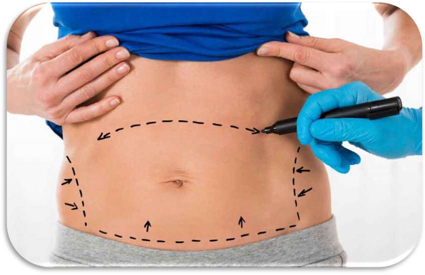 معرفی عمل لیپوماتیک ناحیه شکم و کمر