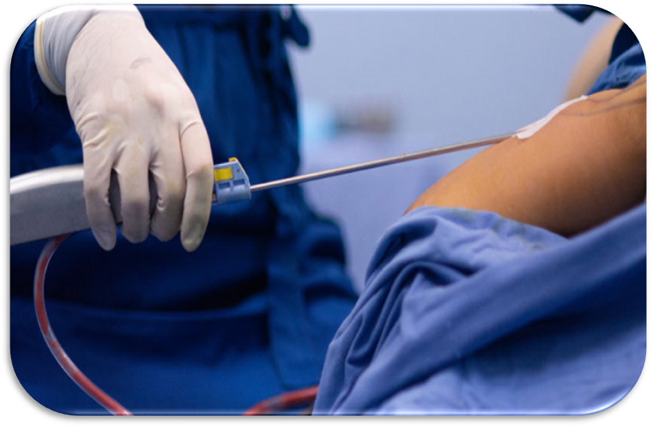 معرفی عمل لیپوماتیک ناحیه شکم و کمر