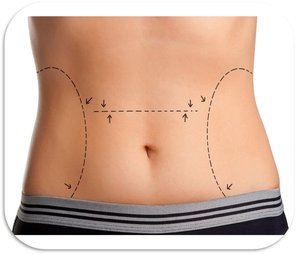 معرفی عمل لیپوماتیک ناحیه شکم و کمر معرفی عمل لیپوماتیک ناحیه شکم و کمر
