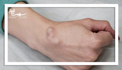 علل بروز کیست مچ دست و ترفندهای سنتی برای درمان آن