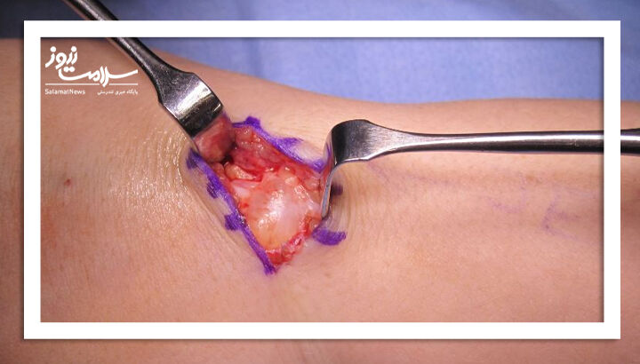 جراحی کیست گانگلیون