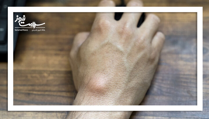 درمان های خانگی کیست گانگلیون دست