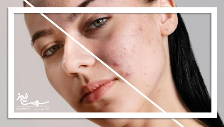 تشخیص عدم تعادل هورمونی در زنان از روی پوست تشخیص عدم تعادل هورمونی در زنان از روی پوست