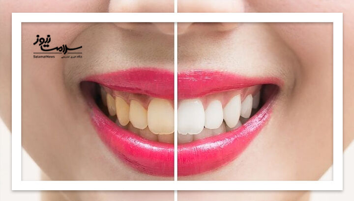 عادت های ساده ای که دندان هایتان را زرد می کند عادت های ساده ای که دندان هایتان را زرد می کند