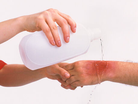 چند باور غلط درباره سوختگی / استفاده از خمیردندان و سیبزمینی ممنوع چند باور غلط درباره سوختگی / استفاده از خمیردندان و سیبزمینی ممنوع