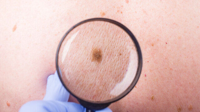 کدام سرطان پوستی خطرناک‌تر است؟