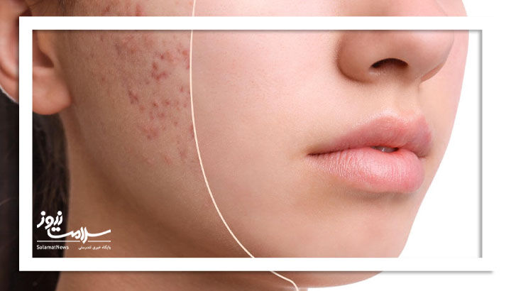 زنان مبتلا به آکنه بار انگ را هم تحمل می کنند زنان مبتلا به آکنه بار انگ را هم تحمل می کنند