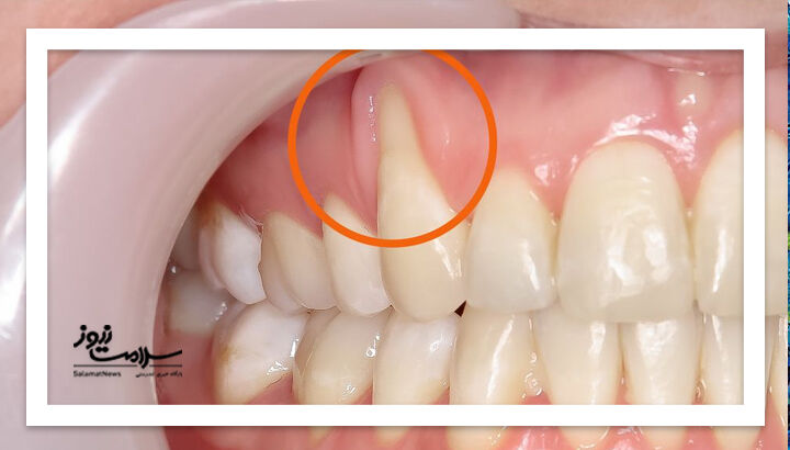 چرا لثههایتان عقب رفته؟ چرا لثههایتان عقب رفته؟