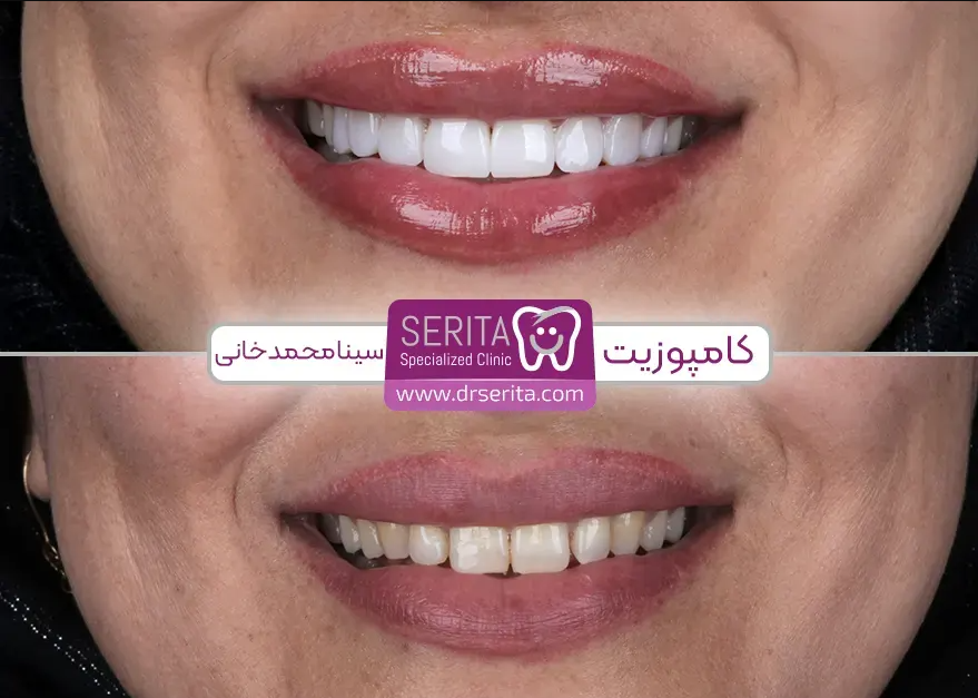 کامپوزیت دندان چقدر هزینه دارد؟