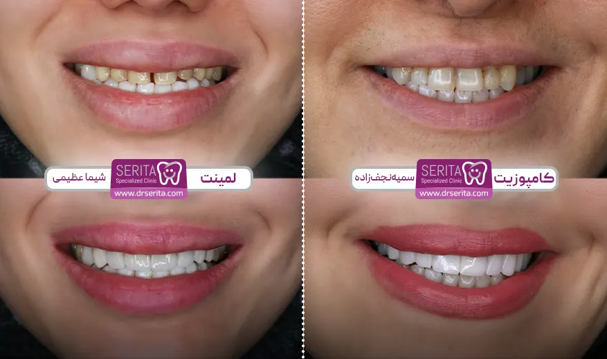 کامپوزیت دندان چقدر هزینه دارد؟