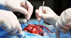 عکس/ اولین عمل جراحی قلب باز در ایران توسط چه کسی انجام شد؟