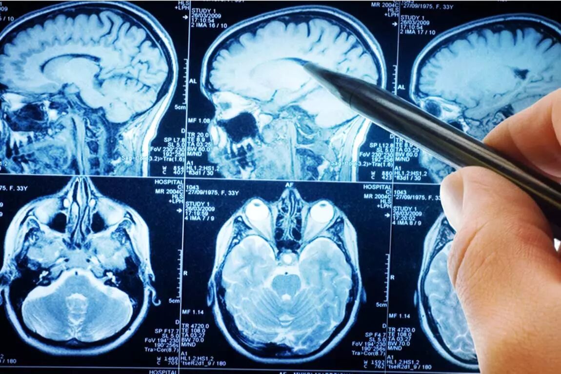 سکته مغزی دومین علت مرگ در ایران / سهم بالاتر مردان در بروز بیماری