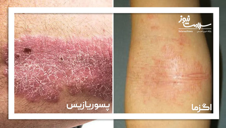 پسوریازیس