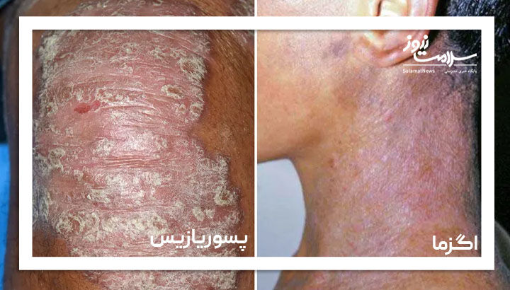 پسوریازیس