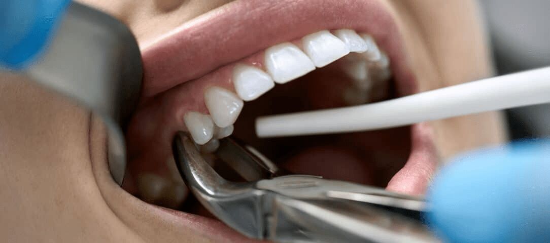 فاصلۀ بین کشیدن دندان و کاشت ایمپلنت چقدر است؟