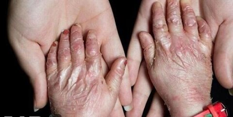 بیماری ای بی و ازدواج‌های فامیلی: ۹۵ درصد مبتلایان از ازدواج‌های فامیلی نتیجه می‌گیرند