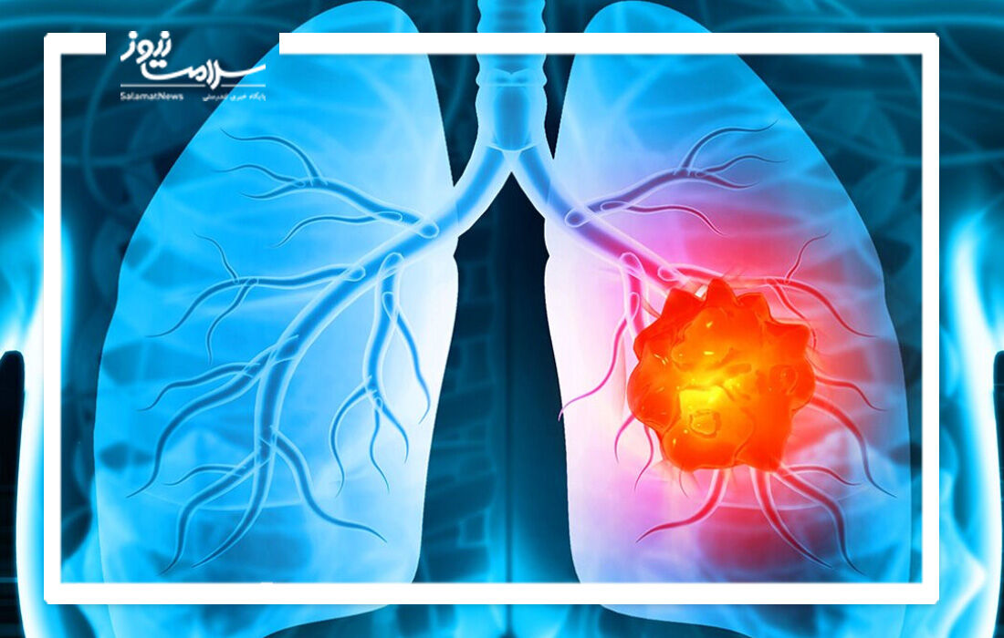 سرطان ریه