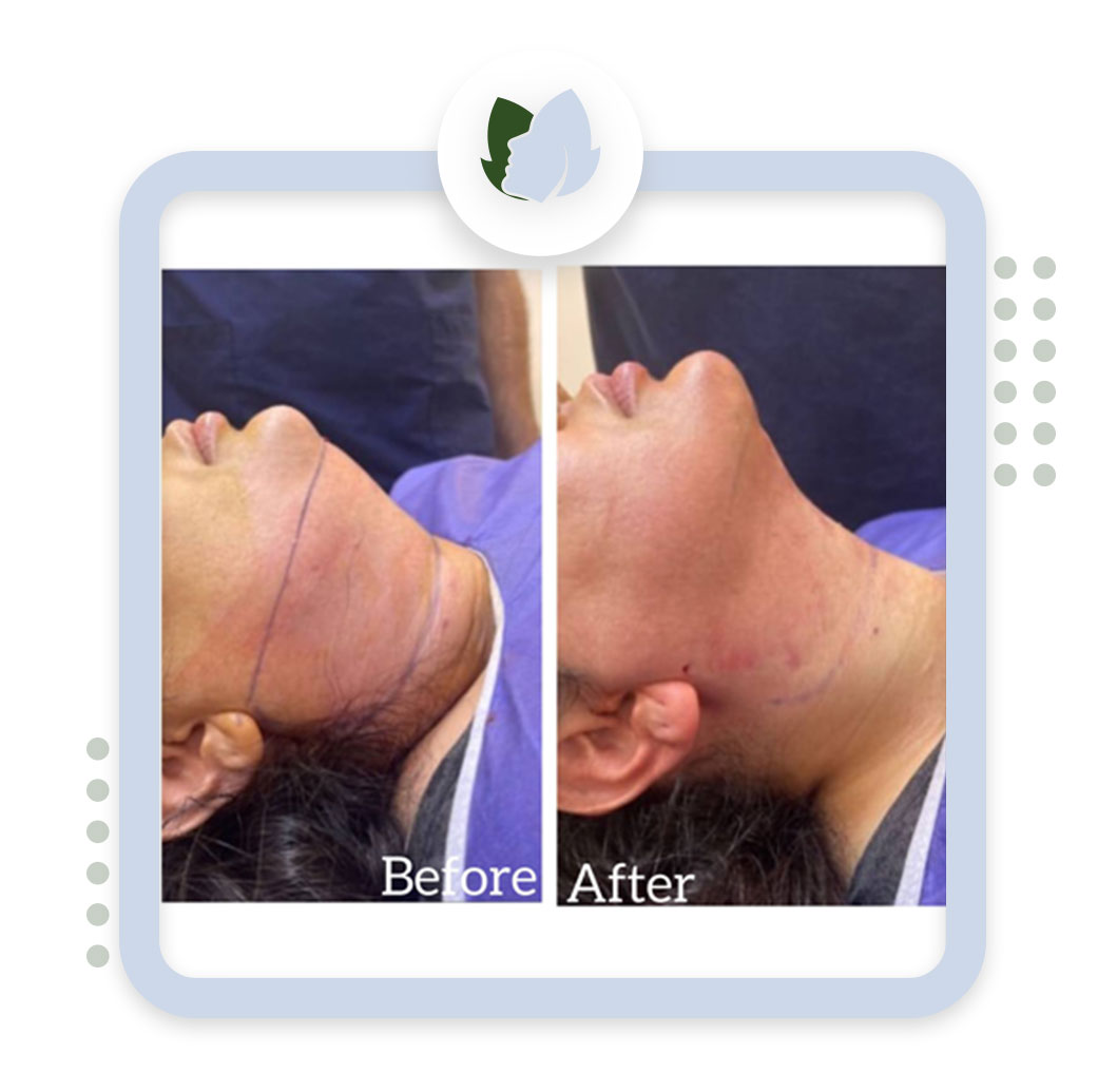 دلایل ایجاد غبغب چیست؟ روش از بین بردن غبغب زیر گلو