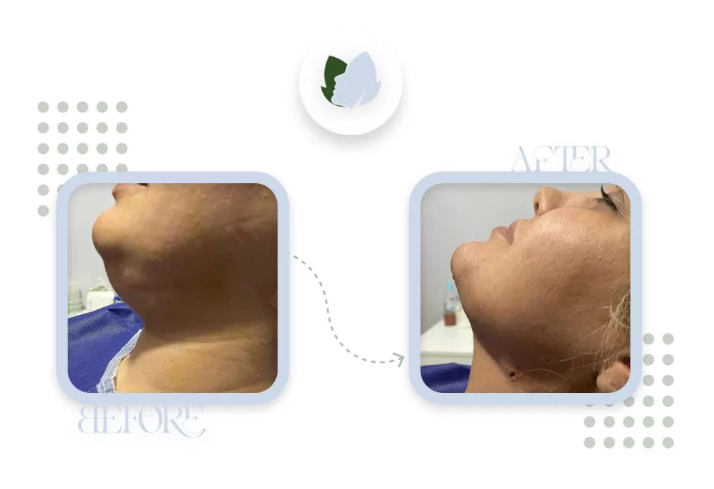 دلایل ایجاد غبغب چیست؟ روش از بین بردن غبغب زیر گلو