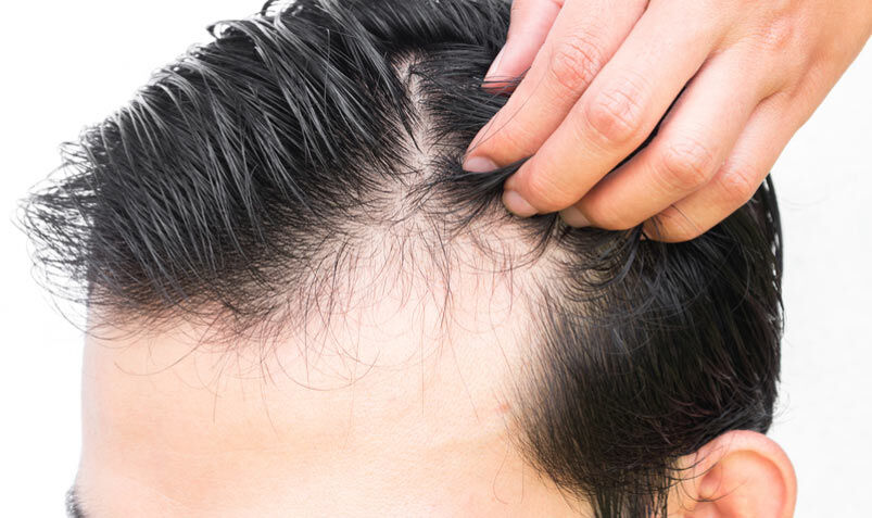 چه زمانی ریزش مو غیرطبیعی است؟