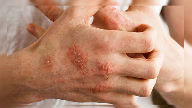 اگزما تاثیر مخرب بر سلامت روان دارد اگزما تاثیر مخرب بر سلامت روان دارد