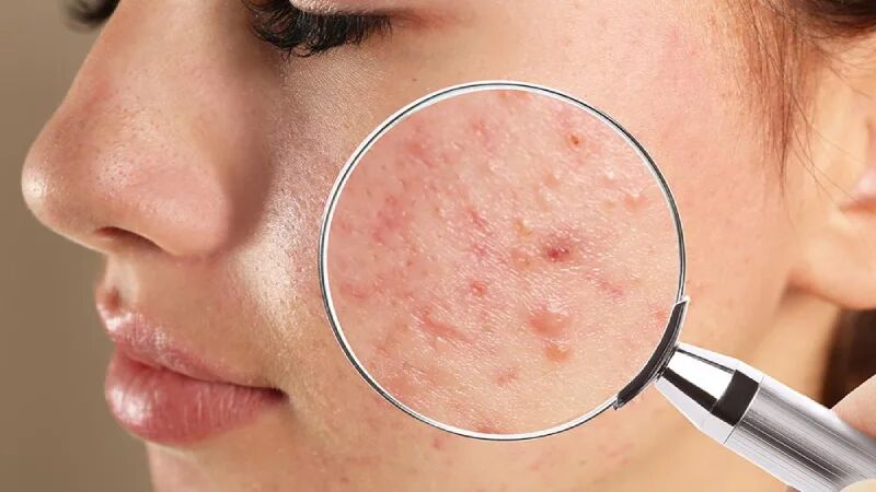 چرا جوش میزنیم؟ چرا جوش میزنیم؟