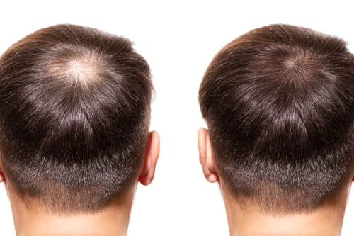 بهترین روش کاشت مو