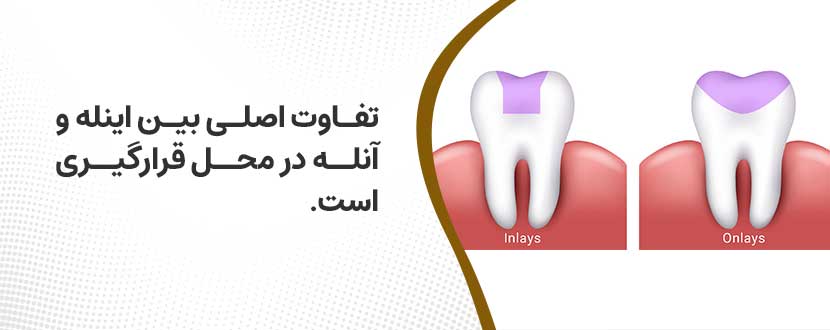 اینله و آنله دندان چیست؟