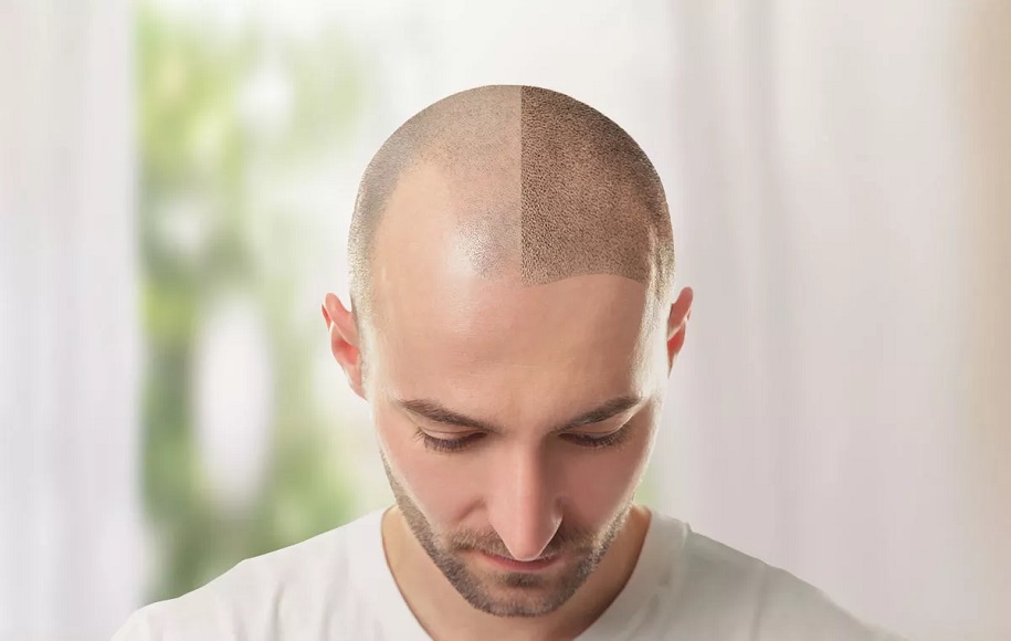 هزینه کاشت مو در سال 1402 به چه صورت است؟ (بررسی فاکتورهای تاثیرگذار)