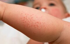 کودکان مبتلا به اگزما بیشتر در خطر سایر بیماری های پوستی هستند