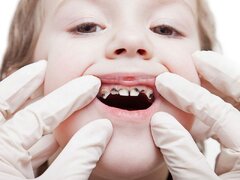 چرا دانش‌آموزان دچار پوسیدگی دندان می‌شوند؟