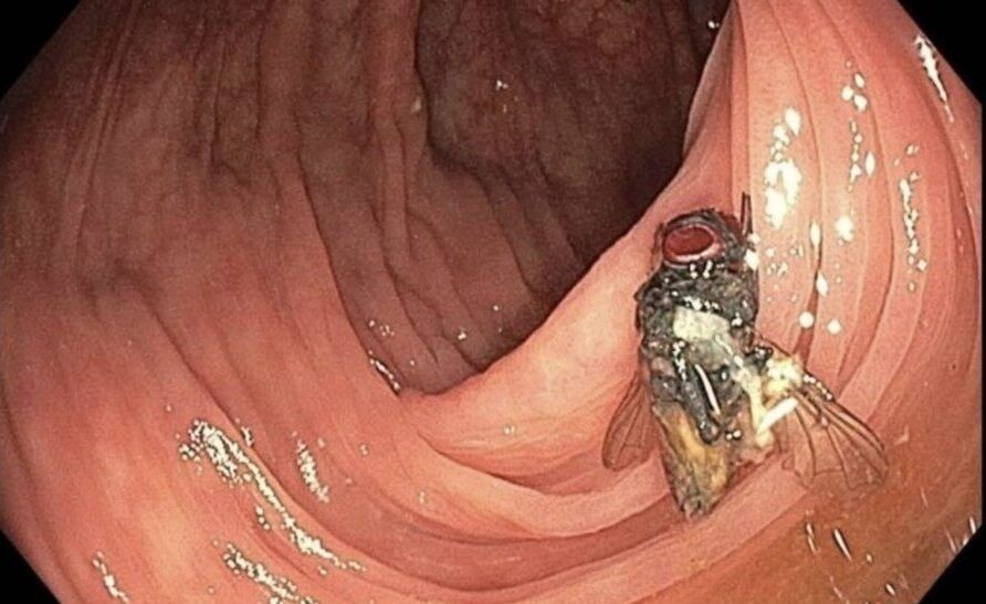 عکس/ کشف مگس زنده در روده یک بیمار حین کولونوسکوپی پزشکان را شوکه کرد