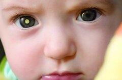 تومورهای چشمی یکی از سرطان‌های شایع در کودکان