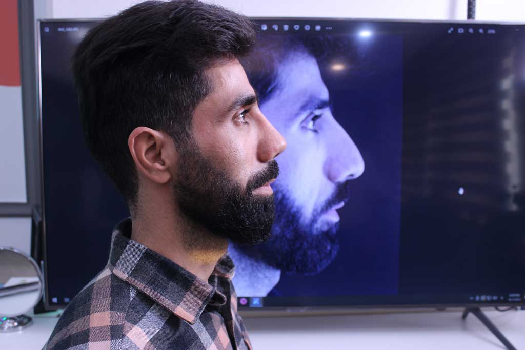 هر آنچه که باید در مورد عمل بینی استخوانی بدانید