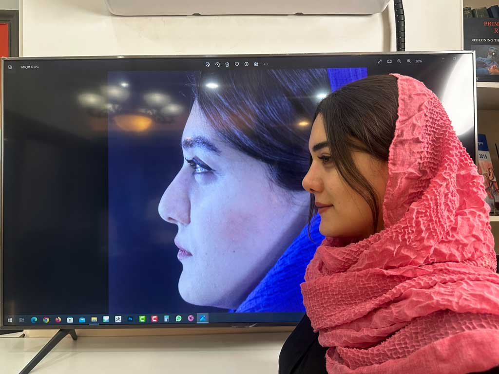 هر آنچه که باید در مورد عمل بینی استخوانی بدانید