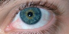 آبی رنگ شدن سفیدی چشم کودک نشانه چیست؟