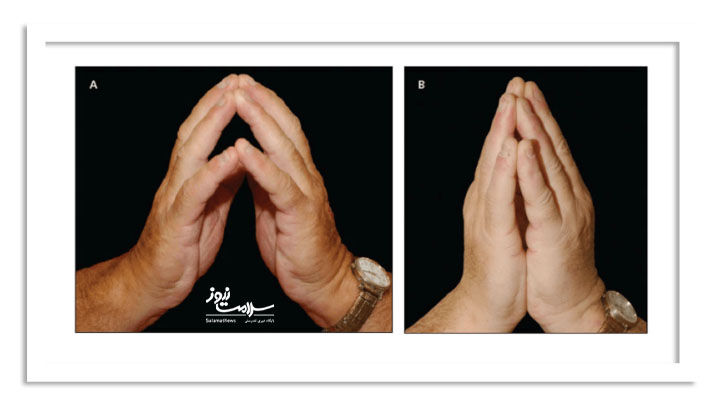 شیروآرتروپاتی