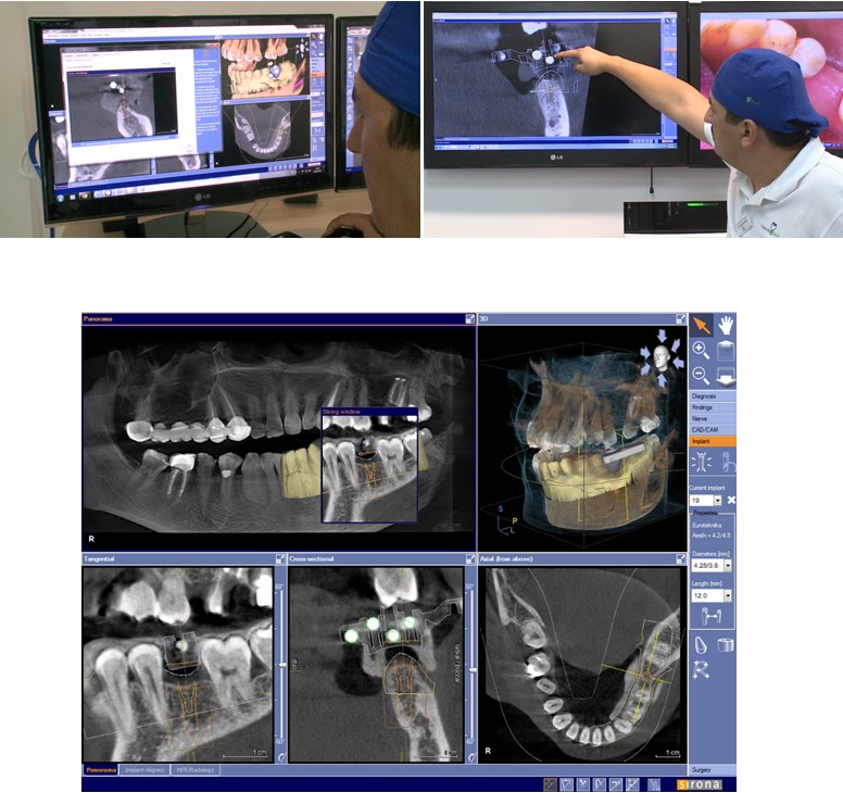 تفاوت ایمپلنت دندان دیجیتال و معمولی چیست؟