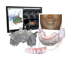 تفاوت ایمپلنت دندان دیجیتال و معمولی چیست؟