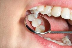 کدام مواد غذایی از پوسیدگی دندان‌ها پیشگیری می‌کنند؟