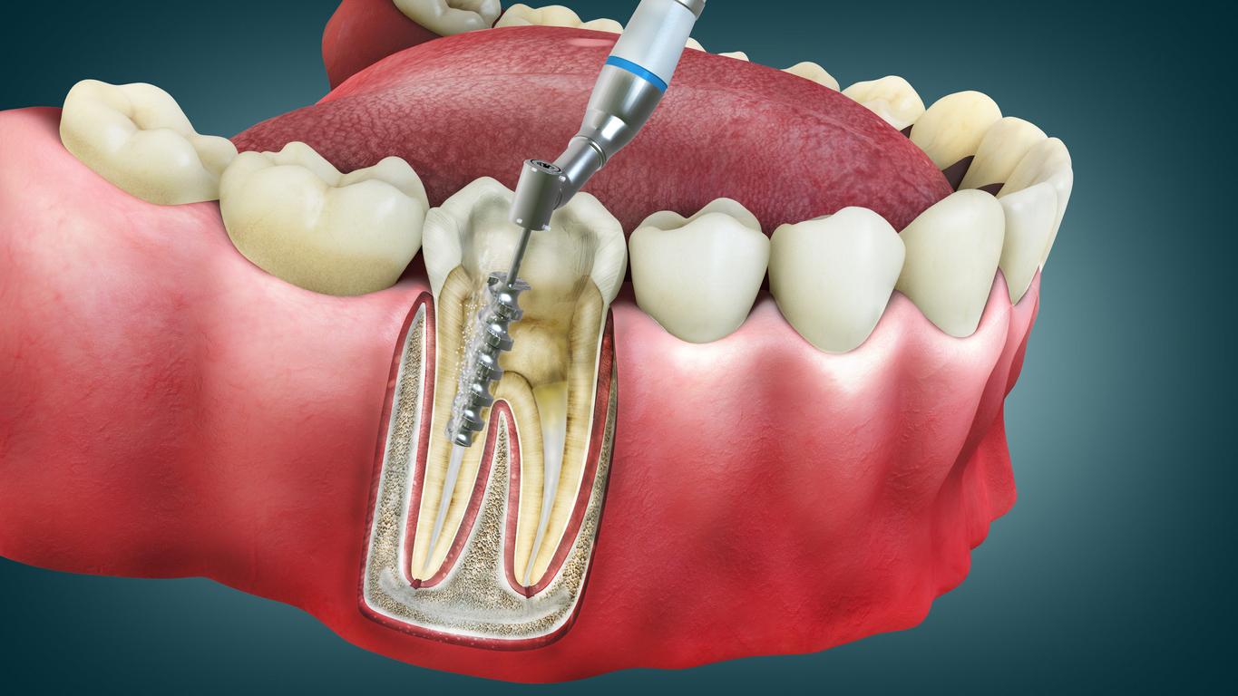 عصب‌کشی: راهکار ایده‌آل برای رهایی از درد و حفاظت دندان‌ها