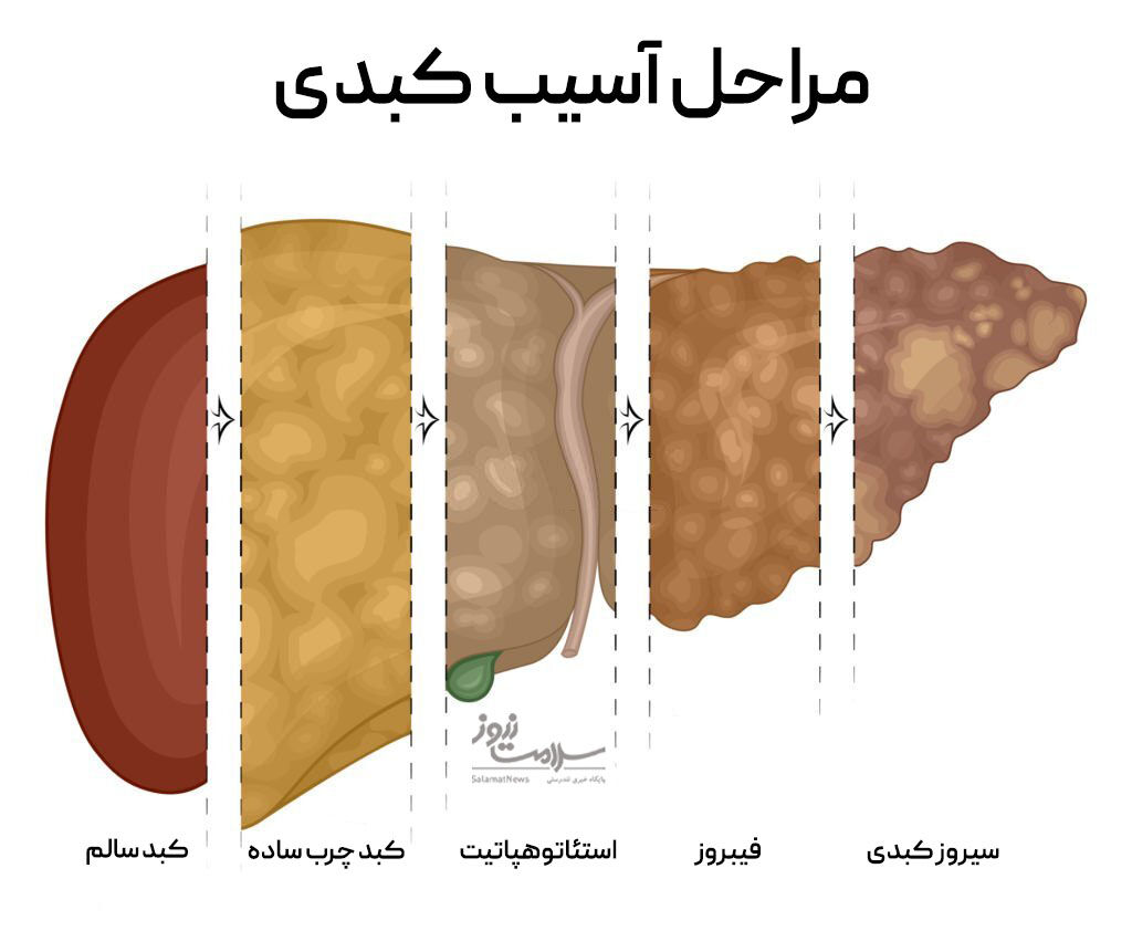برای درمان «کبد چرب» چه بخوریم؟
