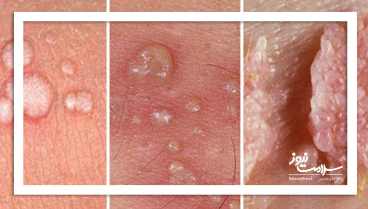 زگیل تناسلی