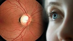 ابتلای ۲۸۸ میلیون نفر به بیماری چشمی دژنراسیون ماکولا تا سال ۲۰۴۰