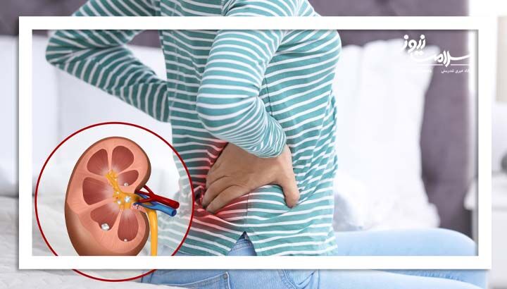 روش های موثر در پیشگیری از سنگ کلیه روش های موثر در پیشگیری از سنگ کلیه